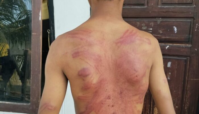 Diduga Dipukul Pakai Selang Berisi Pasir,  Siswa SMK Pelayaran di Kupang Alami Memar